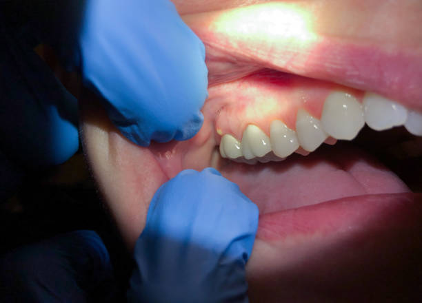 Best Emergency Treatment for Dental Infections or Abscesses in Cascade Chipita Park, CO